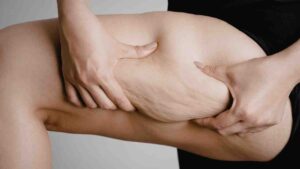 Pelle a buccia d'arancia cosa mangiare - Adorabile.it